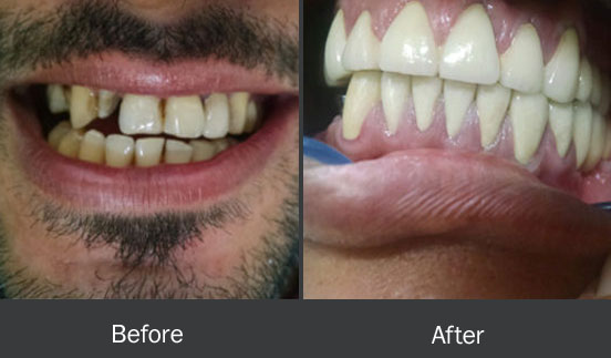 Tooth Crown / Cap